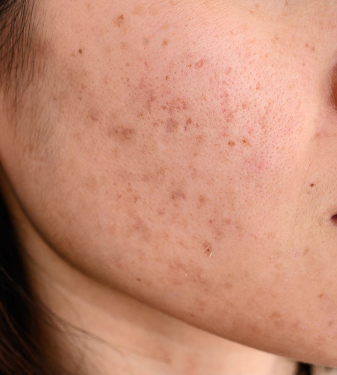 ILOn pigmenttiläiskiin ja epätasaiseen ihonsävyyn kehitetyt tuotteet kirkastavat ja tasoittavat ihoa C-vitamiinin, niasiiniamidin ja probioottien avulla. Hehkuva iho luonnollisesti.