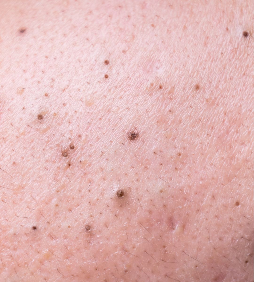 Tukkeutuneet huokoset